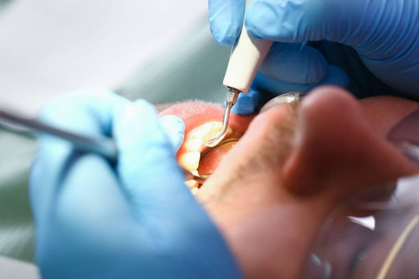 Best Broken or Cracked Tooth Emergency Dentist in Old Stine, CA
